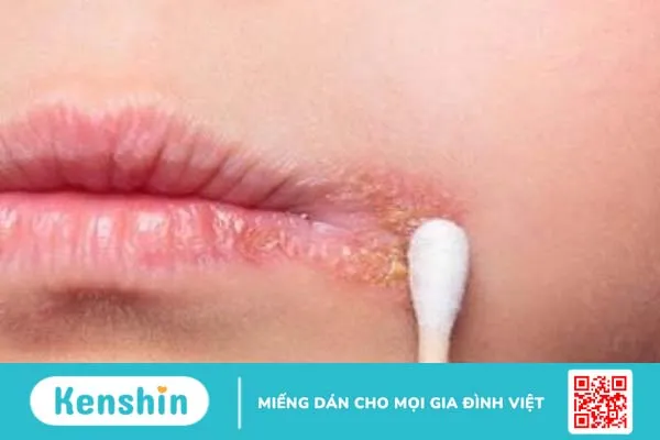 Phác đồ điều trị Herpes môi giúp kiểm soát các triệu chứng 1