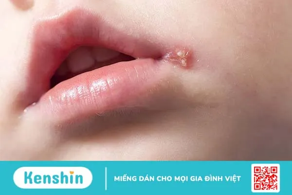 Phác đồ điều trị Herpes môi giúp kiểm soát các triệu chứng 2