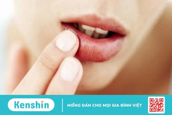 Phác đồ điều trị Herpes môi giúp kiểm soát các triệu chứng 3