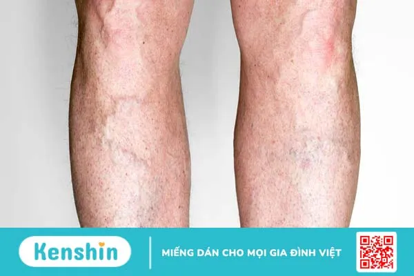 Phác đồ điều trị suy giãn tĩnh mạch chi dưới 1