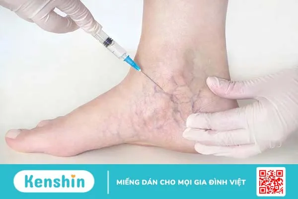 Phác đồ điều trị suy giãn tĩnh mạch chi dưới 2