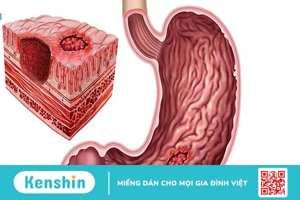 Phác đồ điều trị viêm dạ dày như thế nào? 1