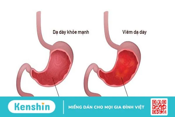 Phác đồ điều trị viêm dạ dày như thế nào? 2