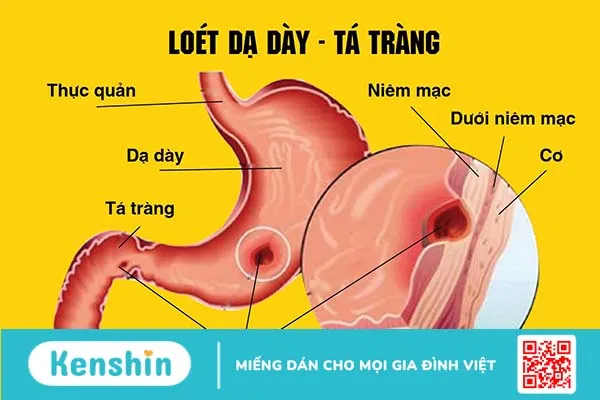 Phác đồ điều trị xuất huyết tiêu hoá hiện nay