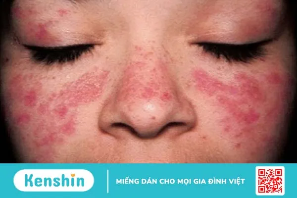 Phác đồ tiếp cận lupus ban đỏ hệ thống ở người trẻ mà bạn nên biết 1