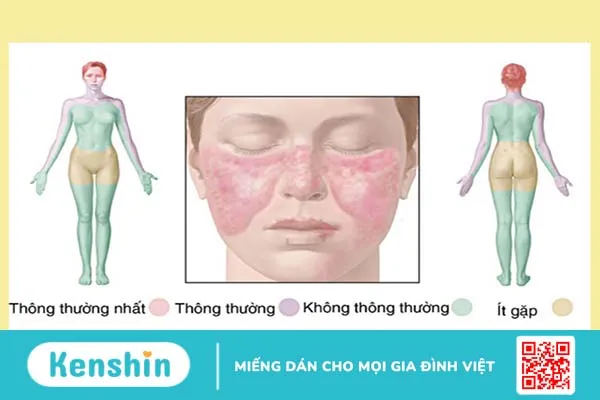 Phác đồ tiếp cận lupus ban đỏ hệ thống ở người trẻ mà bạn nên biết 2