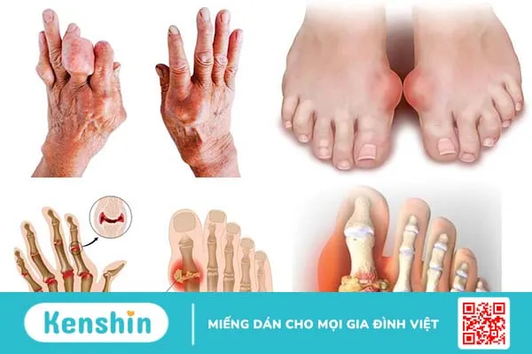 Phân biệt bệnh gout và giả gout 1