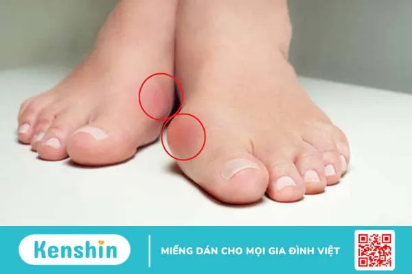 Phân biệt bệnh gout và giả gout 2