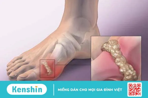 Phân biệt bệnh gout và giả gout 3