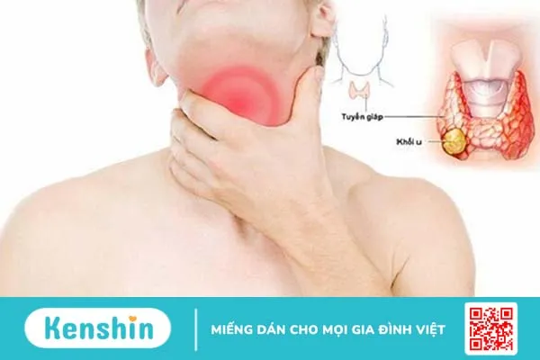 Phân biệt bướu cổ và u tuyến giáp. Nguyên nhân và cách điều trị 2