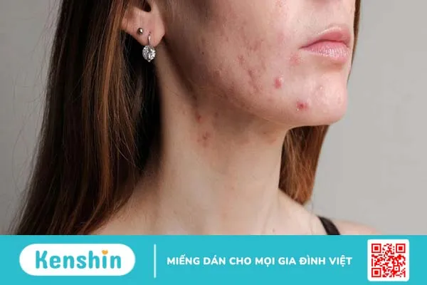 Phân biệt các loại mụn và cách trị mụn đúng chuẩn 4