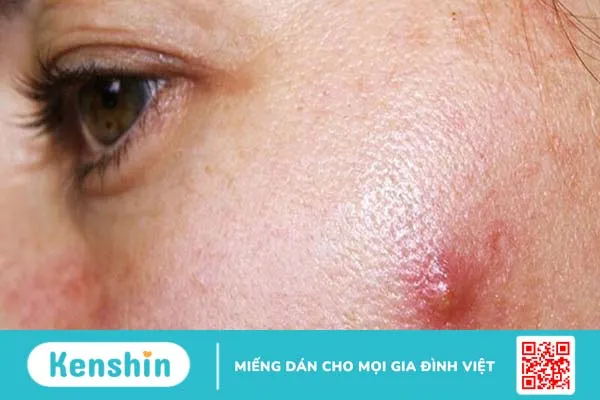 Phân biệt các loại mụn và cách trị mụn đúng chuẩn 3