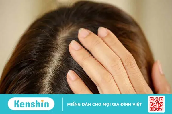 Phân biệt dấu hiệu của bị gàu và bệnh vẩy nến da đầu 2