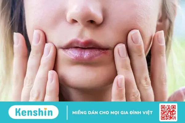 Phân biệt nốt mụn với vết loét lạnh quanh môi 1