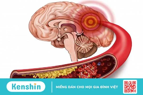 Phẫu thuật dị dạng mạch máu não và cách chăm sóc sau phẫu thuật 1