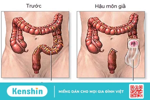 Phẫu thuật làm hậu môn nhân tạo 1