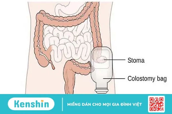 Phẫu thuật làm hậu môn nhân tạo 2