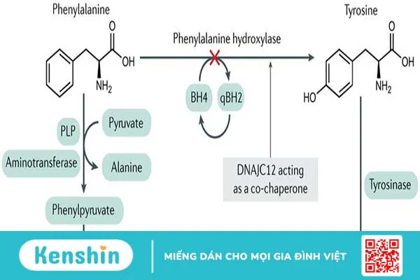 Phenylketone niệu (PKU): Nguyên nhân, triệu chứng và điều trị 2