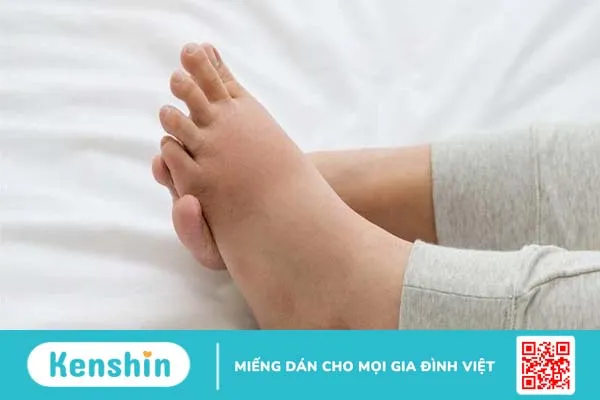 Phù chân khi mang thai tháng cuối và những điều mà bạn cần biết 2