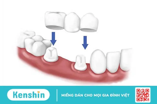 Phục hình răng là gì? Có những phương pháp phục hình răng nào?-1