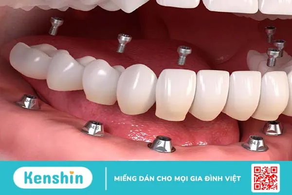 Phục hình răng là gì? Có những phương pháp phục hình răng nào?-4