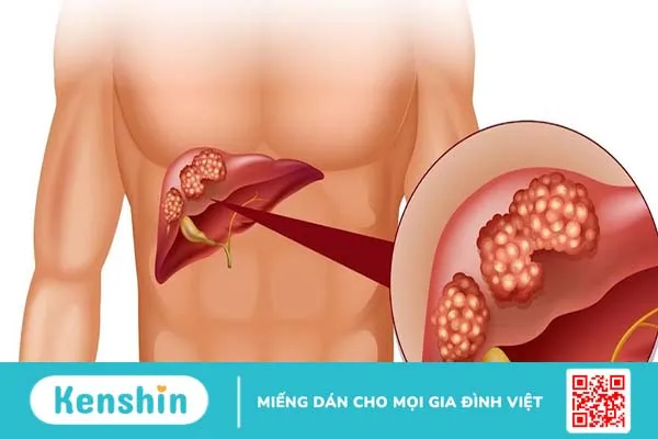 Phương pháp chuẩn đoán và phác đồ điều trị viêm gan cấp