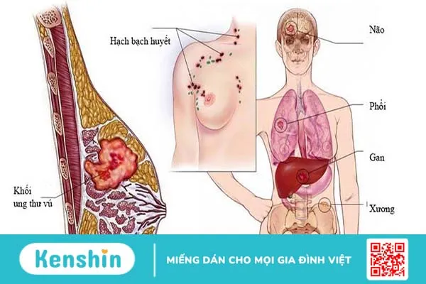 Ung thư vú di căn phổi