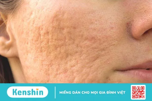 Tretinoin trị sẹo rỗ là câu hỏi thắc mắc của nhiều người