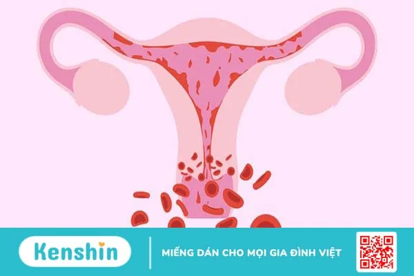 Polyp cổ tử cung bị hoại tử khi mang thai nguy hiểm như thế nào? 1