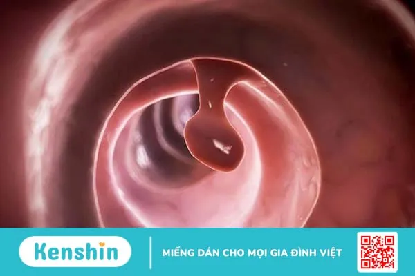 Polyp tử cung có mang thai được không? 3