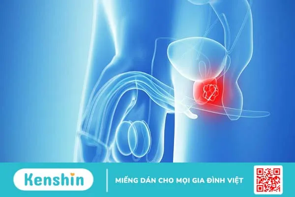 Prostate cancer là gì? Triệu chứng và các giai đoạn của bệnh 1