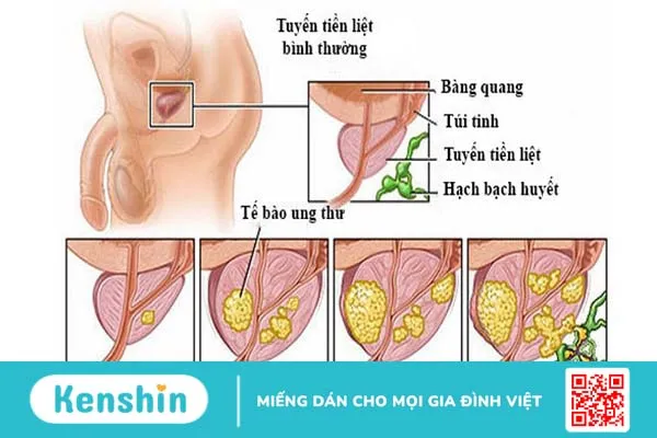 Prostate cancer là gì? Triệu chứng và các giai đoạn của bệnh 3