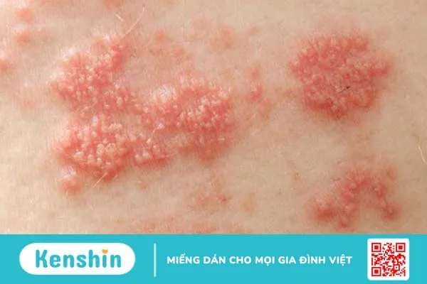 Quá trình lupus ban đỏ thường xuất hiện triệu chứng nào? 4 thực phẩm người mắc bệnh lupus ban đỏ nên tránh xa 1