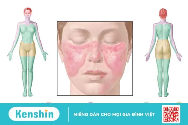 Quá trình lupus ban đỏ thường xuất hiện triệu chứng nào? 4 thực phẩm người mắc bệnh lupus ban đỏ nên tránh xa 2