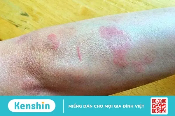 Quá trình lupus ban đỏ thường xuất hiện triệu chứng nào? 4 thực phẩm người mắc bệnh lupus ban đỏ nên tránh xa 3