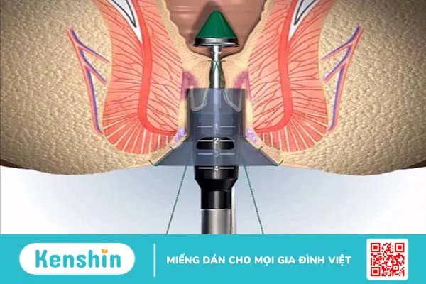 Quy trình khám trĩ ở bệnh viện Bình Dân 2