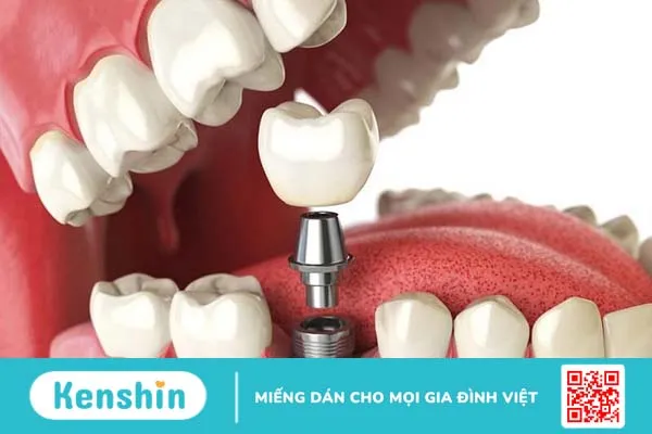 Quy trình trồng răng Implant như thế nào? Những thông tin cần biết 1