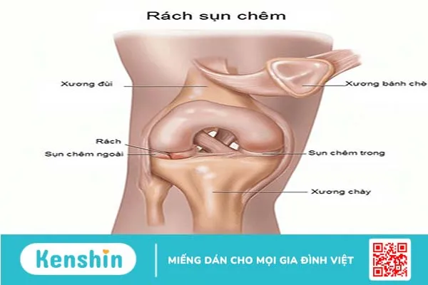 Rách sụn chêm bao lâu thì khỏi? Cần chú ý điều gì khi thực hiện các bài tập phục hồi chức năng? 1