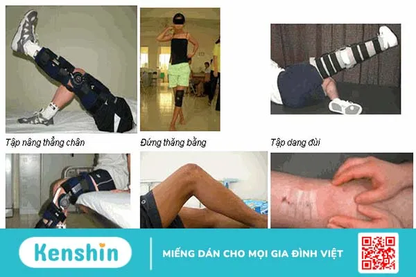 Rách sụn chêm bao lâu thì khỏi? Cần chú ý điều gì khi thực hiện các bài tập phục hồi chức năng? 4