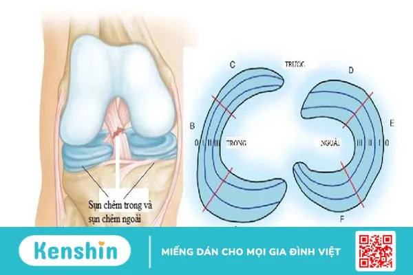 Rách sụn chêm: Dấu hiệu, nguyên nhân và hướng điều trị 1