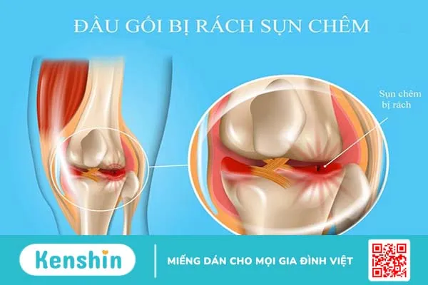 Rách sụn chêm: Dấu hiệu, nguyên nhân và hướng điều trị 2