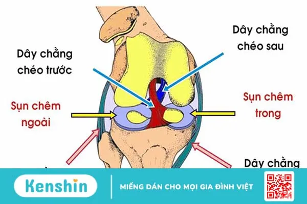 Rách sụn chêm: Dấu hiệu, nguyên nhân và hướng điều trị 3