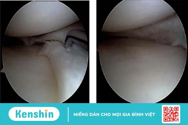 Rách sụn chêm: Dấu hiệu, nguyên nhân và hướng điều trị 4