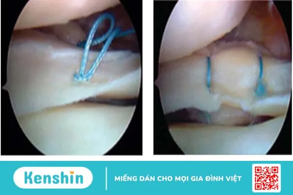 Rách sụn chêm: Dấu hiệu, nguyên nhân và hướng điều trị 5