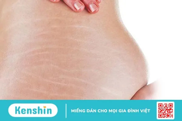 rạn da mông tuổi dậy thì có hết không 2