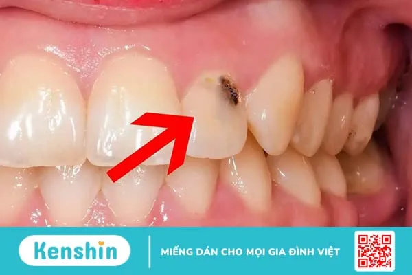 Răng có vết đen: Nguyên nhân và cách chữa trị hiệu quả 1