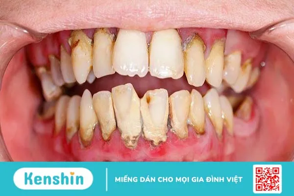 Răng có vết đen: Nguyên nhân và cách chữa trị hiệu quả 2