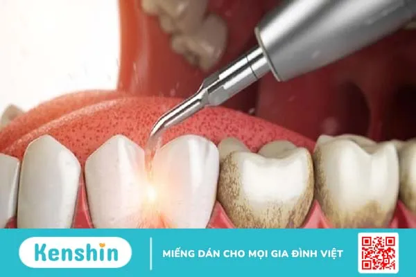 Răng có vết đen: Nguyên nhân và cách chữa trị hiệu quả 3