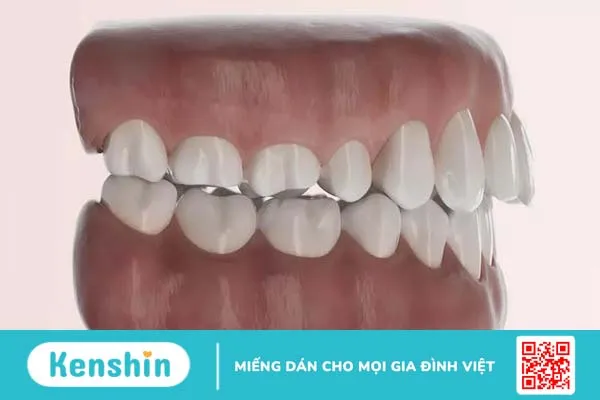 Răng hô nhẹ: Nguyên nhân, tác hại và phương pháp khắc phục 2