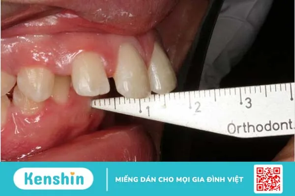 Răng lồi xỉ là gì, nguyên nhân và cách điều trị 1